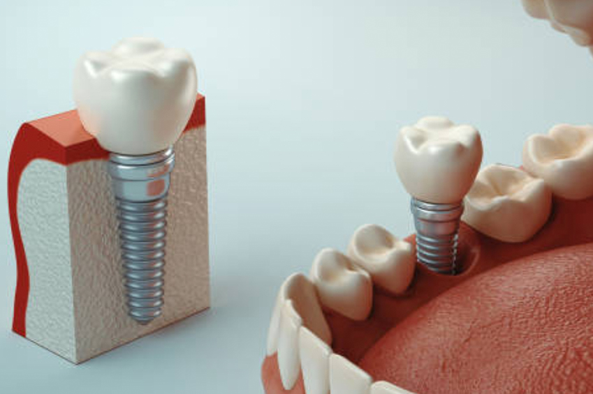 Dental Implants North York