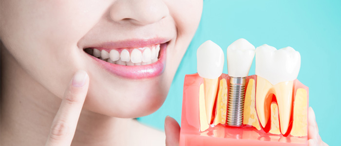 Dental Implants, Dentist in North York Toronto