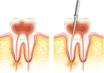 Root Canal Treatment North York
